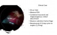 Masive Subretinal Hemorrage and Combined PDR Retinal Detachment