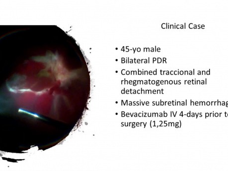 Masive Subretinal Hemorrage and Combined PDR Retinal Detachment
