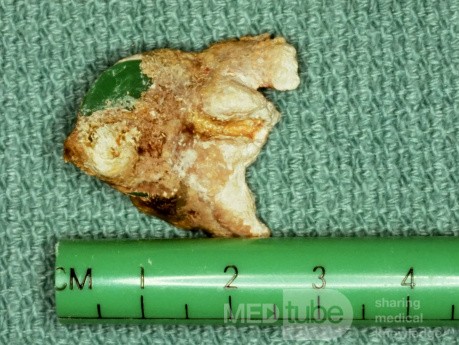 Rhinolith Surgical Specimen