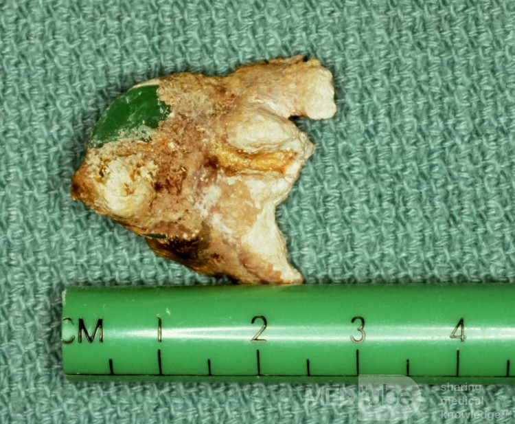 Rhinolith Surgical Specimen