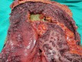 Multiple Rectal Ulcers (95 of 110)