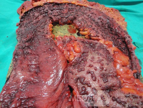 Multiple Rectal Ulcers (95 of 110)