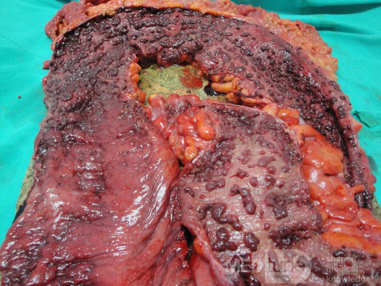 Multiple Rectal Ulcers (95 of 110)
