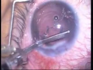 Phacoemulsification In Keratoconus 