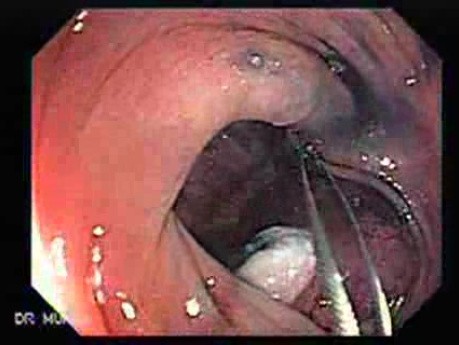 Colonoscopic Polypectomy (18 of 23)