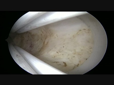 SM Fibroid, Operative Resectoscope