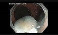 Transverse Colon EMR - Prior Failed and Incomplete Resection