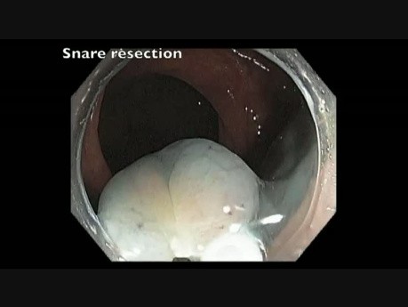 Transverse Colon EMR - Prior Failed and Incomplete Resection