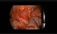 Laparoscopic Resection of Intrauterine Twisted Ovary in Newborn