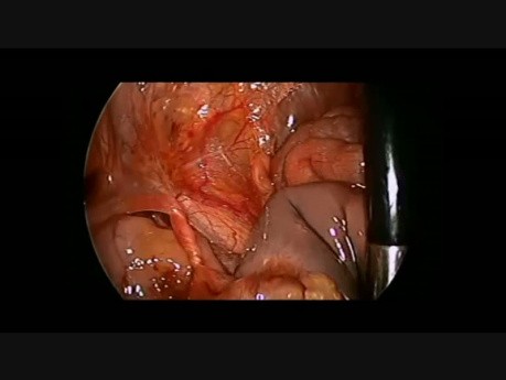 Laparoscopic Resection of Intrauterine Twisted Ovary in Newborn