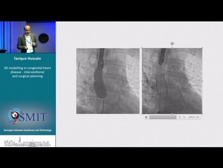 3D Modelling in Congenital Heart Disease - Interventional and Surgical Planning