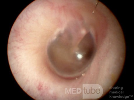 The Normal Eardrum