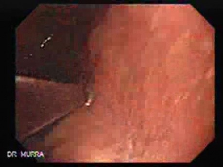 Gastric Cicatrization With Pylorus Stenosis (21 of 23)