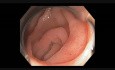Colonoscopy Channel - Subtle Lesion at the Mouth of Appendix