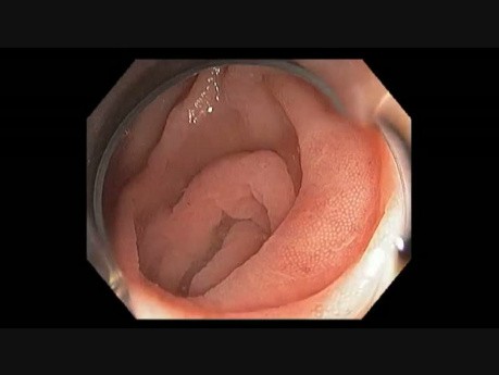 Colonoscopy Channel - Subtle Lesion at the Mouth of Appendix