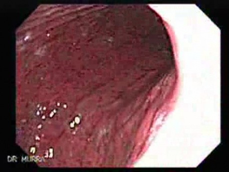 Acute Gastritis (Pangastritis) (5 of 10)