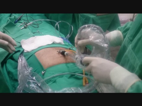 TAPP & TEP Combined Minilaparoscopic Inguinal Hernia Technique