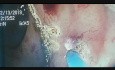 Endoscopic Treatment of Post Radiation Proctitis