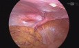 Laparoscopic Inguinal Hernia Technique