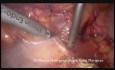 Laparoscopic Resection of Metastatic Nodes After Primary Surgery of Endometrial Cancer 