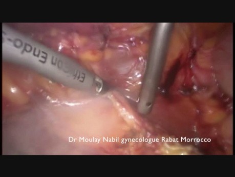 Laparoscopic Resection of Metastatic Nodes After Primary Surgery of Endometrial Cancer 