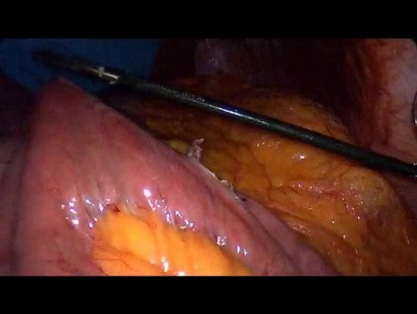 Laparoscopic Gastric Bypass - Part 2