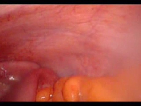 Colonic Perforation With Peritonitis - Laparoscopy (32 of 46)