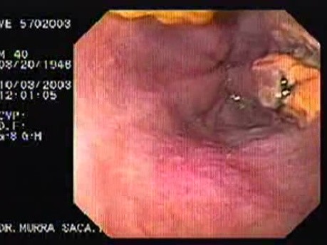Acute Variceal Bleeding - Next Session of Banding