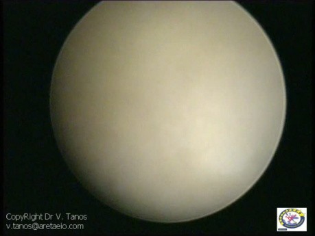  Hysteroscopy  