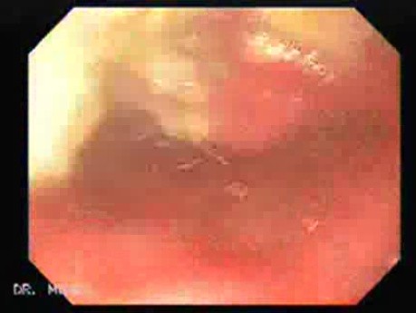 Adenocarcinoma of the Corpus and Antrum (1 of 5)