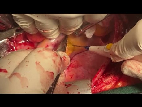 Papillary Muscle Tumor Undergone Resection with Mitral Valve Replacement