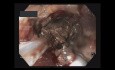 Direct Endoscopic Necrosectomy
