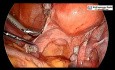 Laparoscopic Hysterectomy With Ureteral Stent Placement