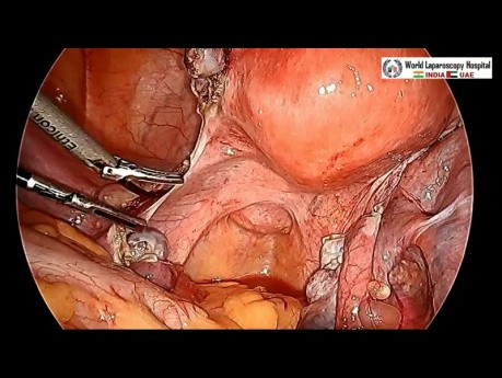Laparoscopic Hysterectomy With Ureteral Stent Placement