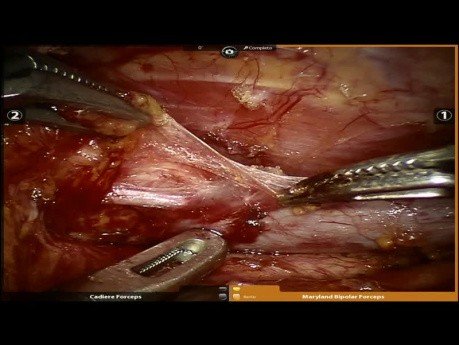 Robotic Thoracic Approach to Treat Parathyroid Adenoma
