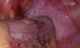 Laparoscopic Sigmoidectomy with Liver Metastectomy