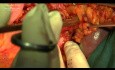 Radical Proximal Spleen Preserving Gastrectomy with D2 Lymphadenectomy