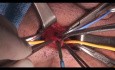 Varicocelectomy - Bilateral Approach