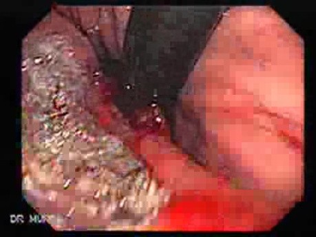 Adenocarcinoma of the Lesser Curvature (2 of 3)