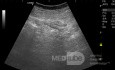 Appendicular Abscess USG 1