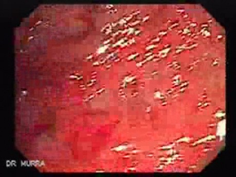 Multiple Rectal Ulcers (2 of 110)