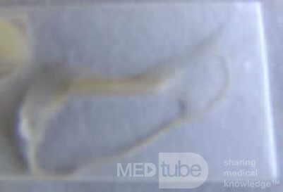 Colonoscopy observing a trichuris in the cecum (8 of 8)
