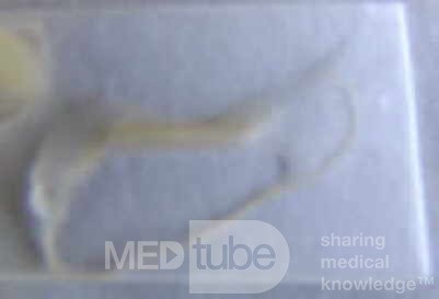 Colonoscopy observing a trichuris in the cecum (8 of 8)