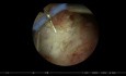 En Bloc TURBT For Bladder Cancer Over Ureteric Orifice