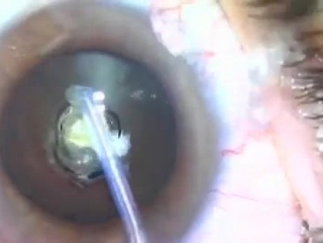 Fugo Blade Nanotechnology - plasma ablation