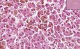 Hemochromatosis-hemosider - Histopathology - Liver, lymph node 