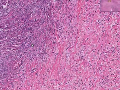 Theca cell tumor - Histopathology of ovary