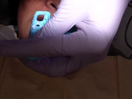 Dental Implant - Open Tray Impression Technique - Tape Over The Port