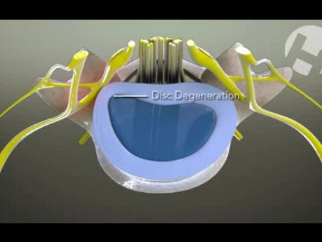 Lumbar Radiculopathy