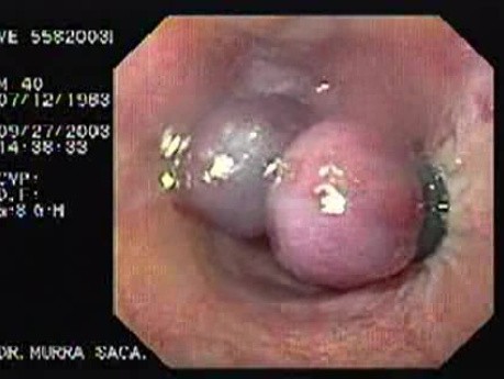 Acute Variceal Bleeding - Varices after Ligation
